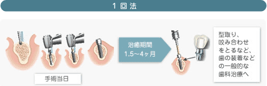 インプラント1回法説明画像