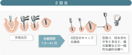 インプラント2回法説明画像