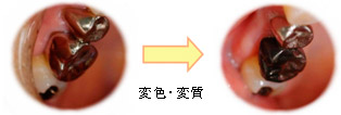 歯科金属の変質写真